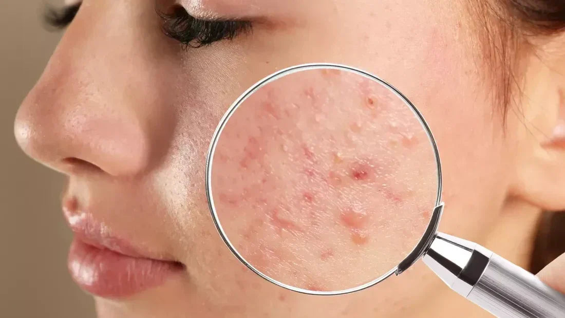 K-beauty anti-acné : les ingrédients stars pour une peau sans boutons
