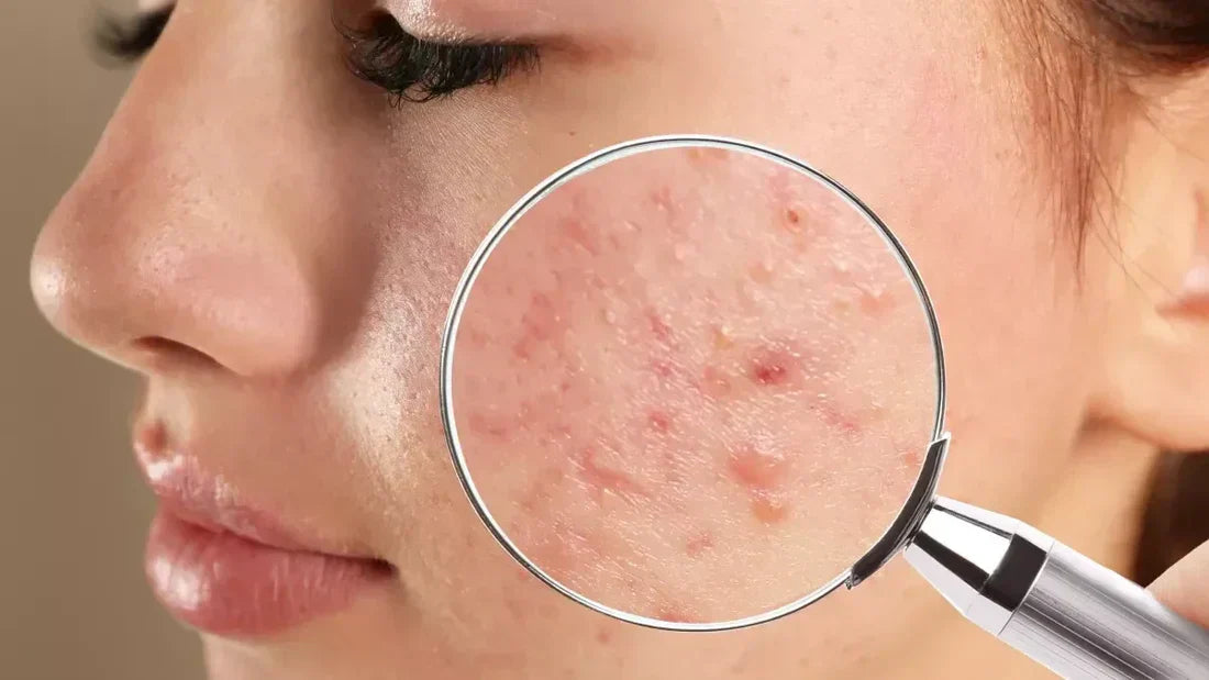 K-beauty anti-acné : les ingrédients stars pour une peau sans boutons